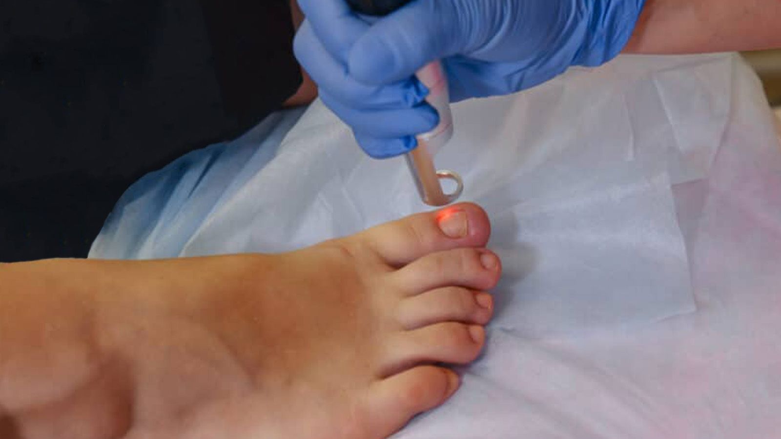 Laser nail fungus treatment for men at Bodyland